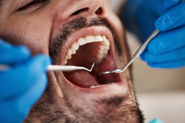 Best Emergency Dental Care for Broken or Chipped Teeth in Bel Ridge, MO